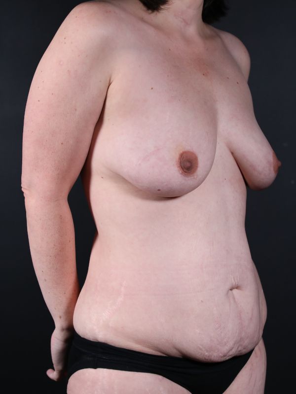 Mommy Makeover Before & After Image