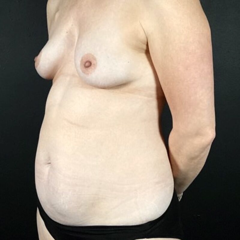 DIEP Flap Breast Reconstruction Before & After Image