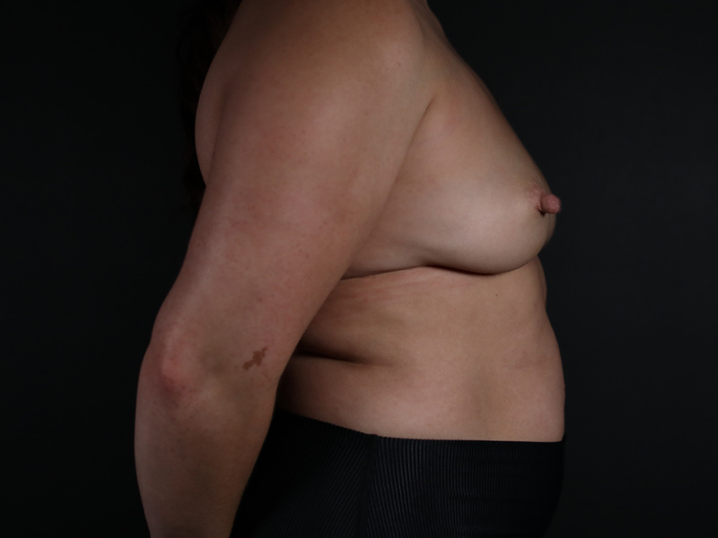 Breast Augmentation Before & After Image