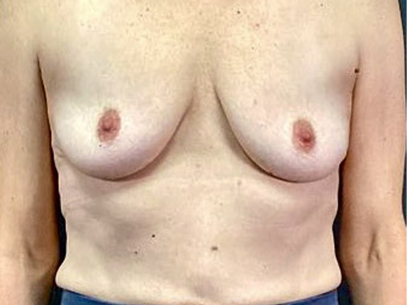 Breast Augmentation Before & After Image