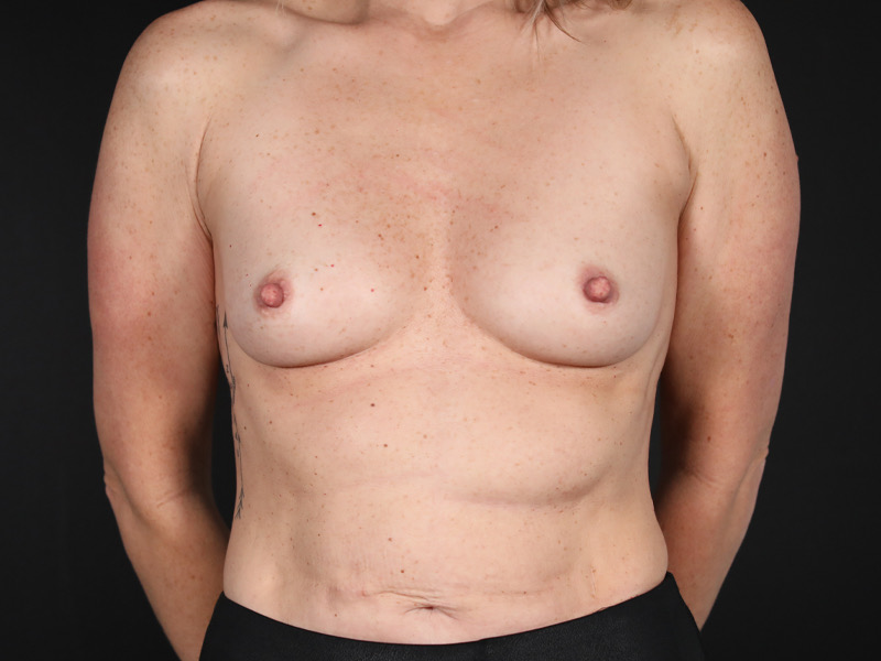 Breast Augmentation Before & After Image