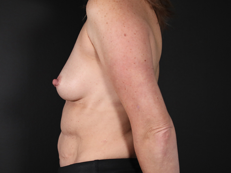 Breast Augmentation Before & After Image