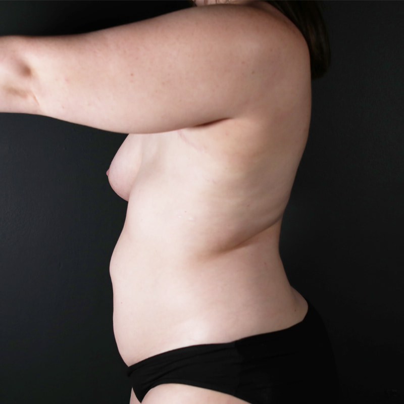 Breast Reconstruction Before & After Image