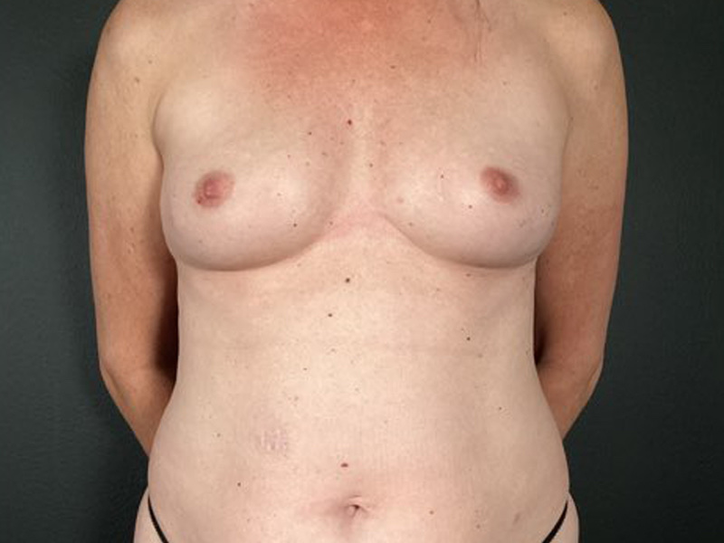 Implant Reconstruction Before & After Image